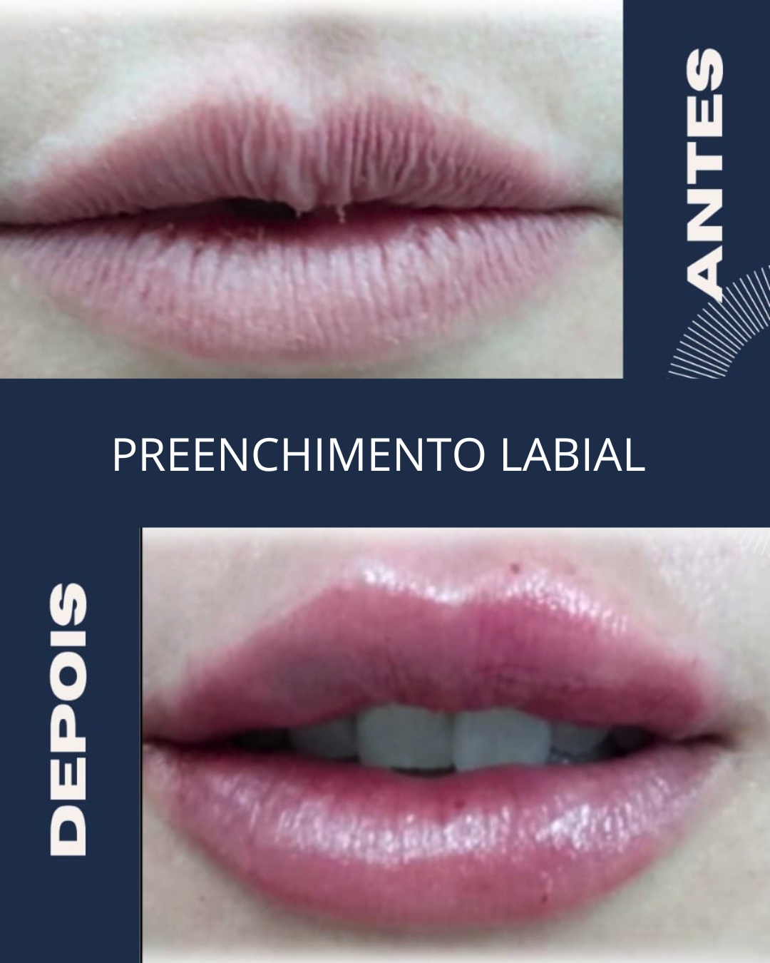 01 labial novo