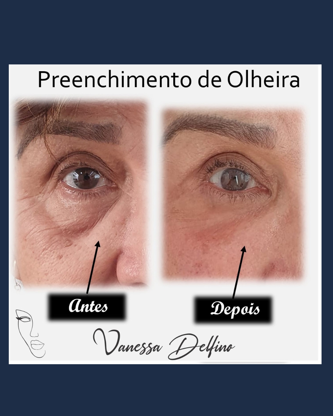 ANTES E DEPOIS PREENCHIMENTO DE OLHEIRA