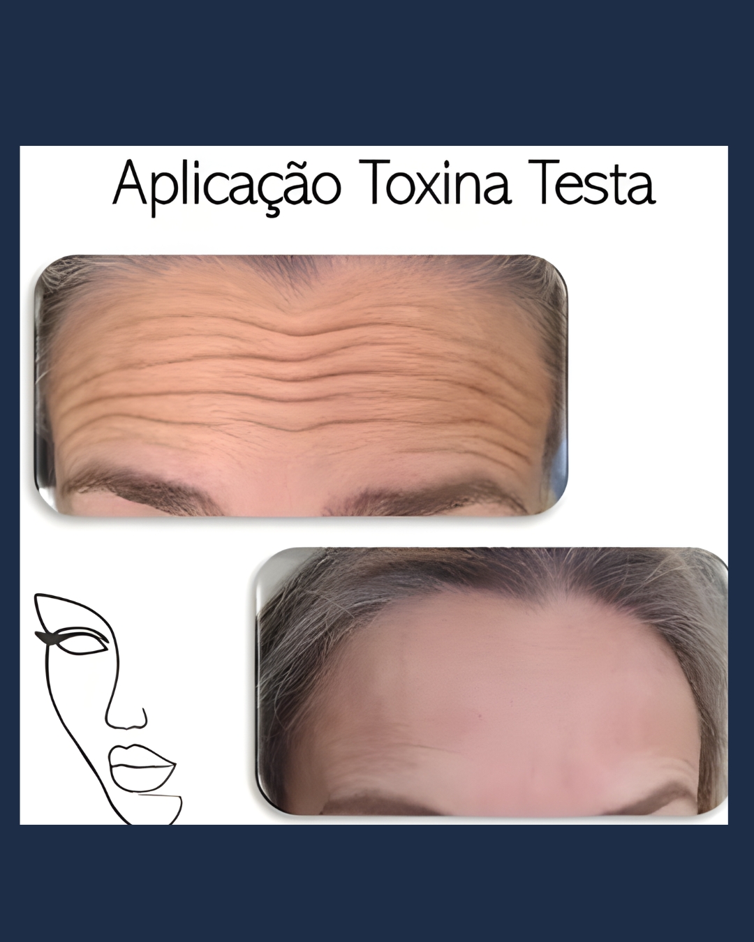 Aplicação toxina