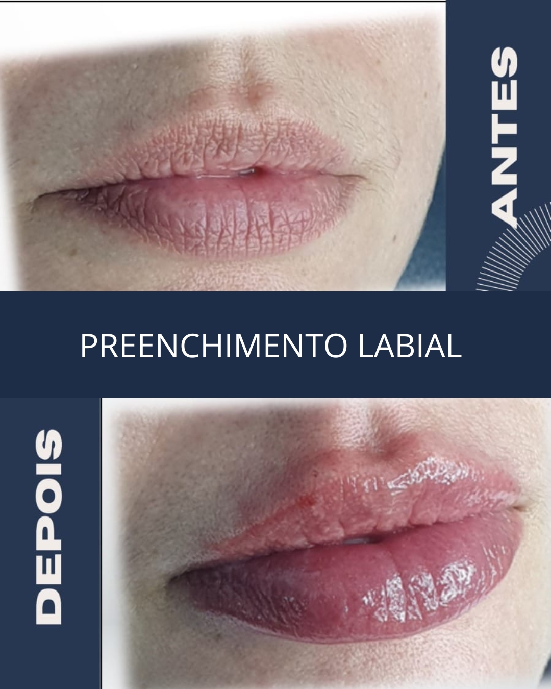 Preenchimento labial 02